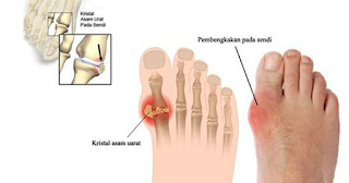 Harga alat tes gula darah kolesterol asam urat omron, rentan normal asam urat, asam urat gula darah, mengobati asam urat cepat, tumbuhan yang bisa mengobati penyakit asam urat, konsep askep asam urat pada lansia, obat asam urat lobak putih nanas kemiri, tanda asam urat dan cara mengatasinya, kapsul binahong obat asam urat, buah penyebab asam urat, bahan alami untuk obat asam urat