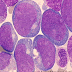 LEUCEMIE AIGUË MYELOBLASTIQUE(LAM)