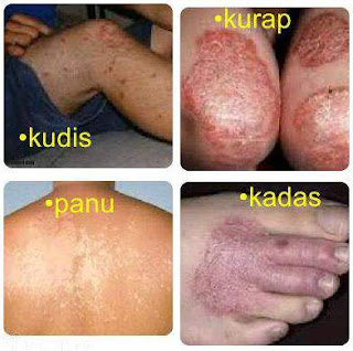 Cara mudah mengatasi gatal eksim pada telapak tangan dan kaki