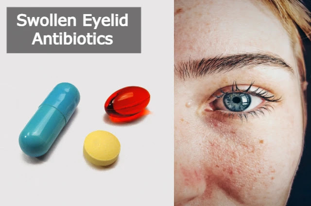 swollen-eyelid-antibiotics