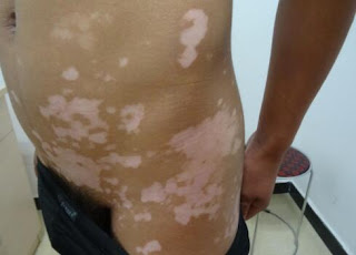 Early symptoms of vitiligo pictures