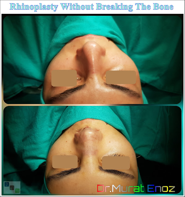 Rhinoplasty Operation Without Breaking The Nasal Bone