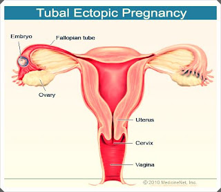 kehamilan ektopik