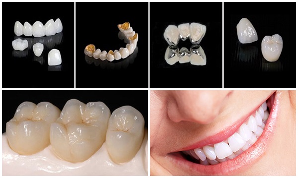 Răng sứ toàn sứ là loại răng sứ tốt nhất để phục hình răng cửa