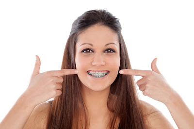 Niềng răng chỉnh móm hiệu quả khi nào?