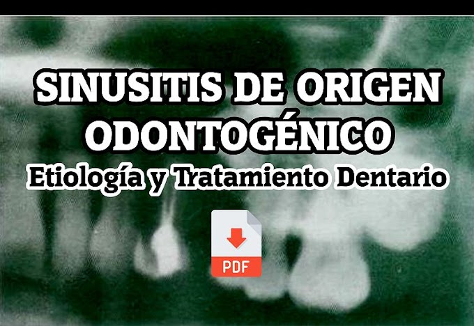 PDF: Sinusitis de Origen Odontogénico - Etiología y Tratamiento Dentario