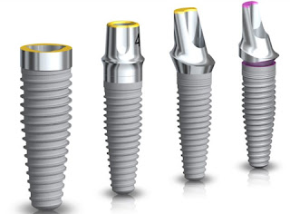 Trồng răng implant mất bao lâu-2