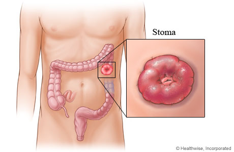 stoma