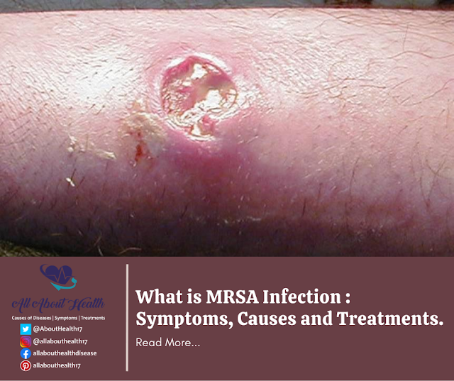 What is MRSA Infection : Symptoms, Causes and Treatments.