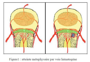 OSTEOMYELITE AIGUE HEMATOGENE.