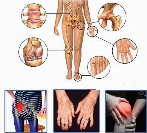 Penawar Gout No 1 di MALAYSIA - Rhizoplus Azzahra 