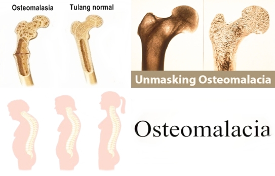 Pengobatan Herbal Osteomalasia