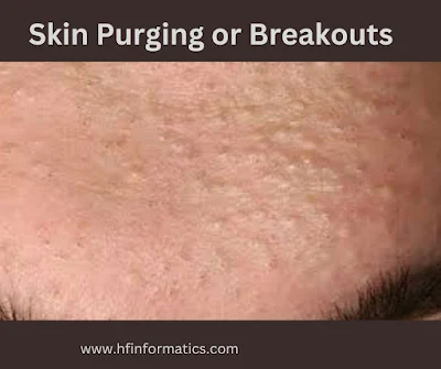 Skin purging or Skin Breakouts