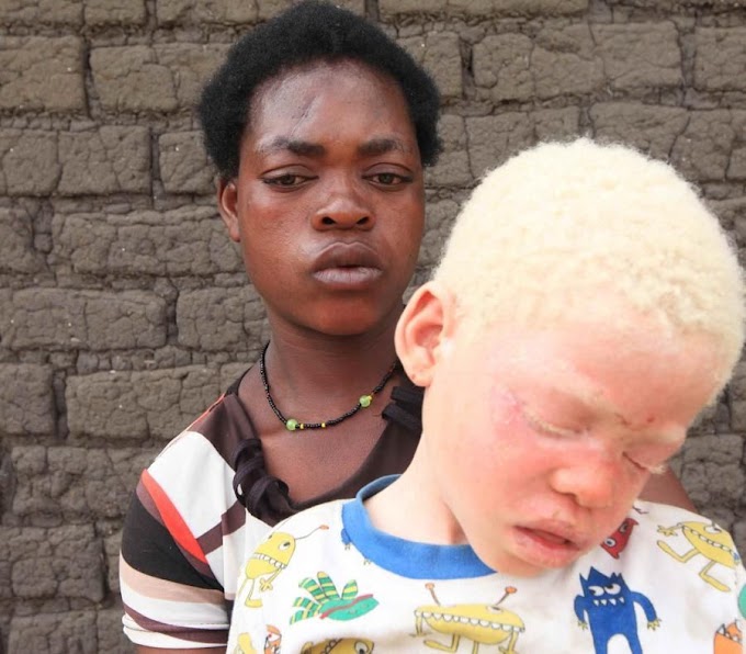 INTERNACIONAL / Por brujería aumentan asesinatos  de albinos en Malaui, denuncia AI