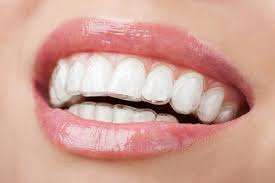 Invisalign sử dụng các khay trong suốt đảm bảo tính thẩm mỹ cho người sử dụng