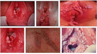 Berapa Harga Obat Kutil Kelamin Gangjie Ghosiah Di px Sumatera Barat