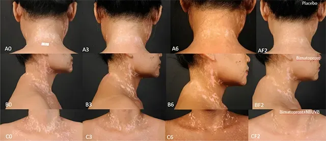 Eficacia del Bimatoprost Oftálmico en la Fototerapia NB-UVB para el Vitiligo no Segmentario y Segmentario