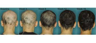 Ayurvedic Treatment Hair Loss