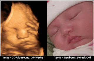 3D Ultrasound Photo Side by Side Comparison with Actual Newborn Baby