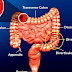 Ulcerative colitis