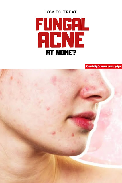 Fungal acne or pityrosporum folliculitis treatment