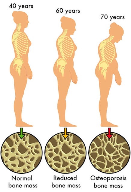 Osteoporosis, osteo, porosis, tulang keropos, tulang rapuh, Jenis-jenis Osteoporosis, Faktor Risiko Osteoporosis, Ciri-ciri Osteoporosis, Diagnosa Osteoporosis, Bahaya Osteoporosis, Pengobatan Osteoporosis, Cara Mencegah Osteoporosis, kepadatan tulang, osteoporosis pada wanita, osteoporosis pada pria, osteoporosis pada anak-anak, osteoporosis pada remaja, osteoporosis pada orang tua, penyebab osteoporosis, definisi osteoporosis, gejala osteoporosis, osteoporosis adalah pengeroposan tulang yang disebabkan oleh, osteoporosis pdf, pencegahan osteoporosis