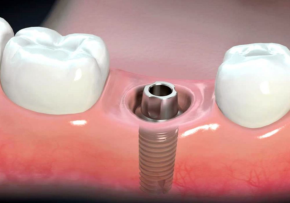 Dental Implants