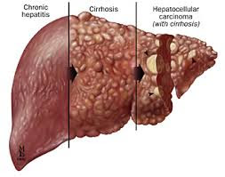 penyebab dan gejala penyakit liver