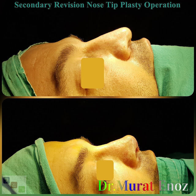 Revision Nose Tip Plasty in Men Istanbul