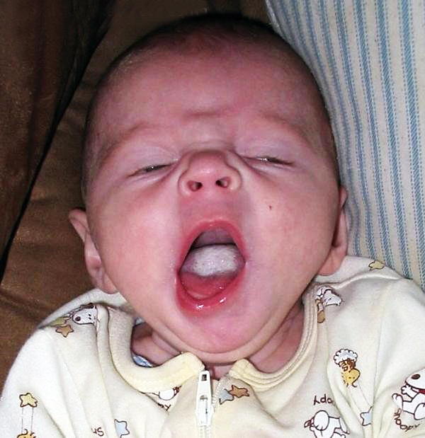 فطريات الفم عند الأطفال وكيفية االعلاج فى المنزل