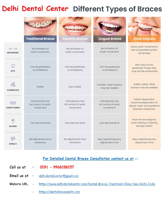 Teeth Braces clinic in Delhi, Teeth braces in Delhi, Teeth Braces dentist in Delhi, Teeth Braces Delhi, Teeth Braces Procedure in Delhi, Teeth Braces Treatment in Delhi.