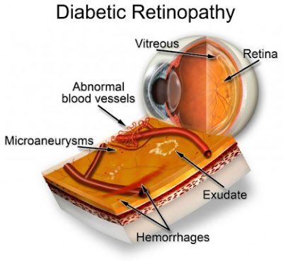 eyes suffer from diabetes