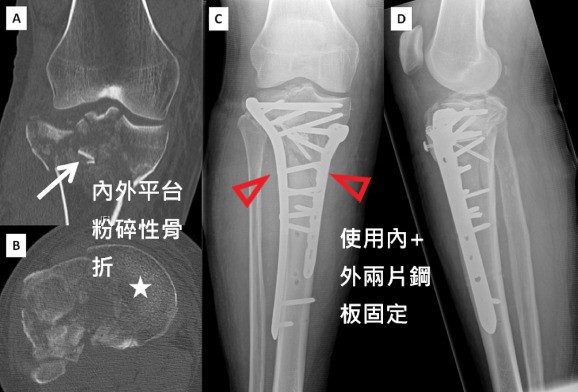 骨科李宜軒醫師 脛骨平台骨折tibia Plateau Fracture 脛骨近端骨折proximal Tibia Fracture