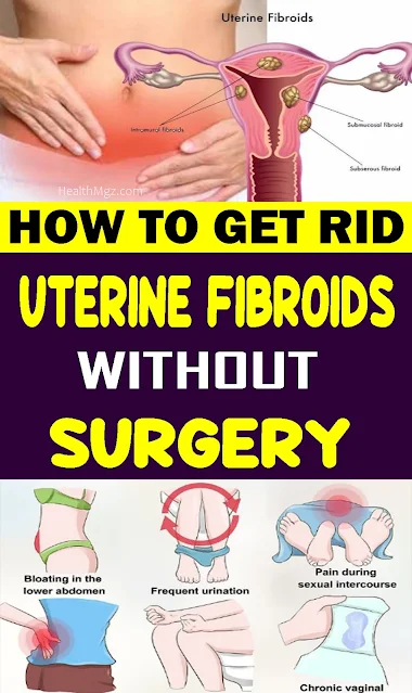 How to Get Rid of Uterine Fibroids without Surgery