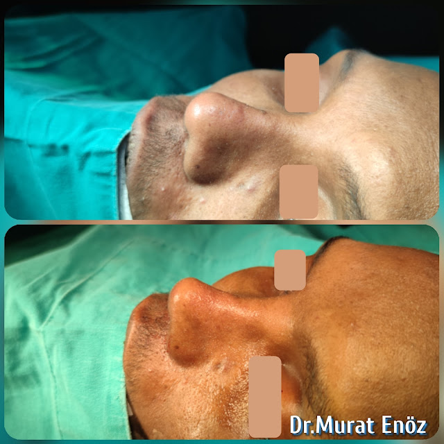 Ethnic Revision Rhinoplasty in Istanbul,Ethnic African Nose Aesthetic, Secondary revision ethnic nose job