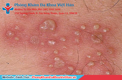 Biểu hiện của bệnh sùi mào gà - Đa khoa Việt Hàn quận 12