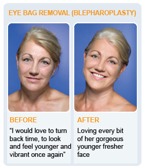 Eye Bag Removal3