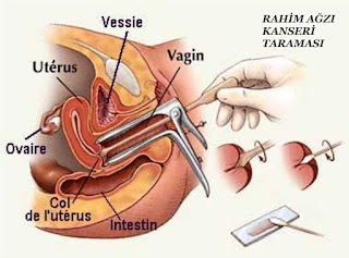 Rahim Ağzı Kanseri Taraması Nasıl Yapılır? 