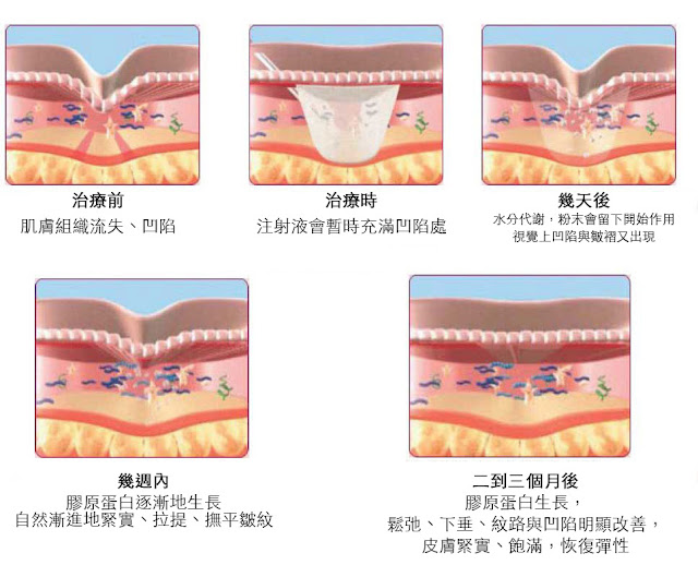 洢蓮絲隆鼻洢蓮絲ellanse聚己內酯PCL依戀詩易麗適洢蓮絲隆鼻費用價格推薦醫師林上立醫師上立皮膚科診所玻尿酸晶亮瓷微晶