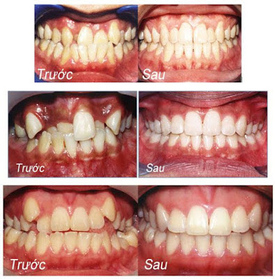  Ưu điểm niềng răng lệch lạc là gì?