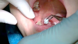 Trồng răng implant có đau không-1