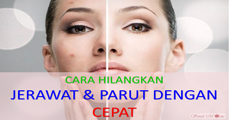 Ubat Jerawat Bernanah - Descar 0