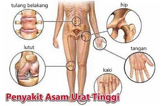 Kadar asam urat tidak normal, tanaman obat asam urat akut, asam urat pada anak-anak, coklat buat asam urat, obat asam urat pil, cuka apel menurunkan asam urat, apakah asam urat boleh minum kopi, obat asam urat penyebab gejala serta pantangannya, buah kersen untuk obat asam urat, cara buat obat tradisional asam urat, lele pantangan asam urat