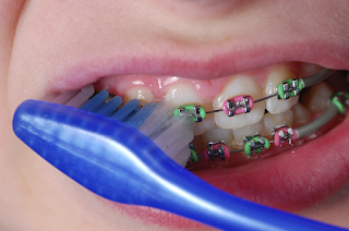 How to Brush Teeth with Braces?