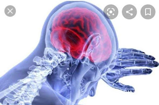 Brain stroke: Symptoms, types, causes, diagnosis, diagnosis and treatment of brain stroke