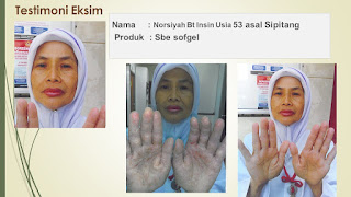 Testimoni Seabucthorn sbe Sofgel Pada Penyakit Kulit Kering Karena Psoriasis