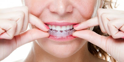 Lưu ý khi ngậm máng tẩy trắng răng tại nhà