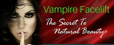  vampire facelift cost