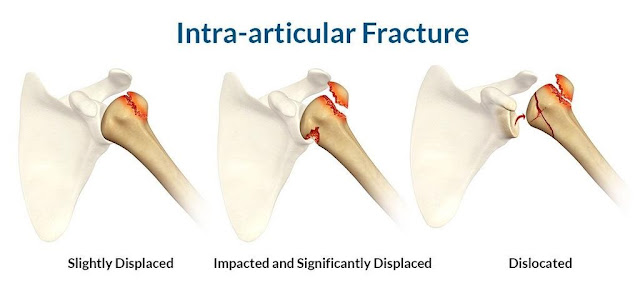 Intraarticular Fractures - Diagnosis and Treatment