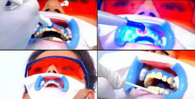 Quy trình tẩy trắng răng theo tiêu chuẩn